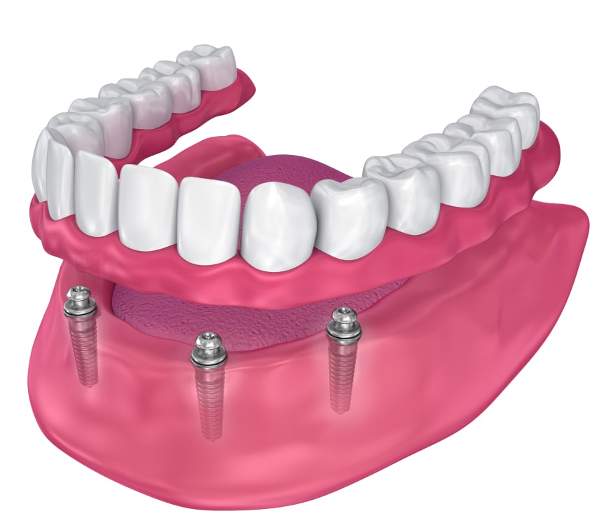 implantoprotetyka odent