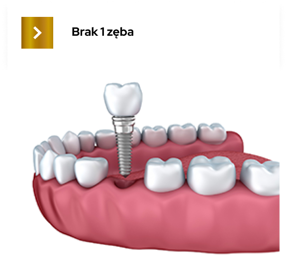 implantoprotetyka