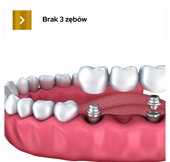 implanty stomatologiczne