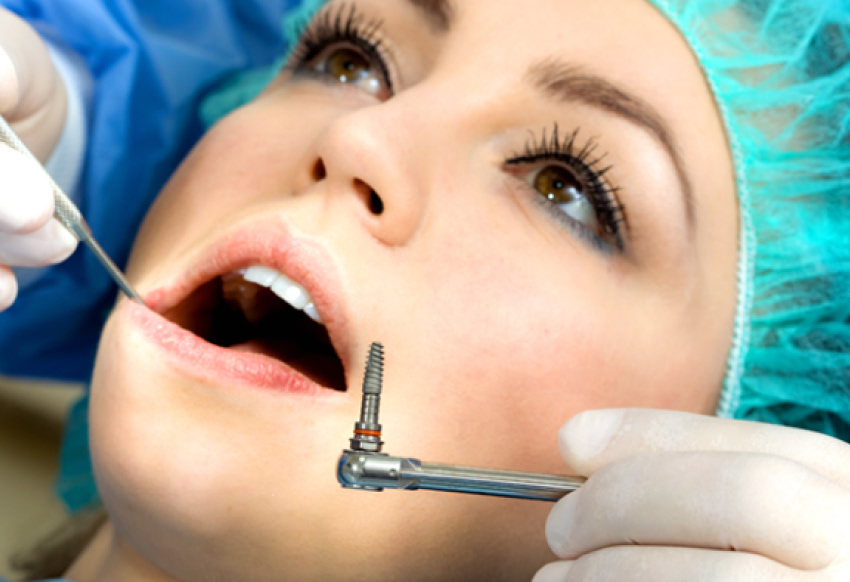 implanty odent