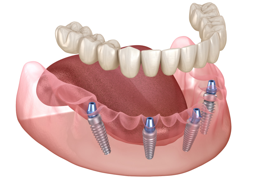 implant prosthetics