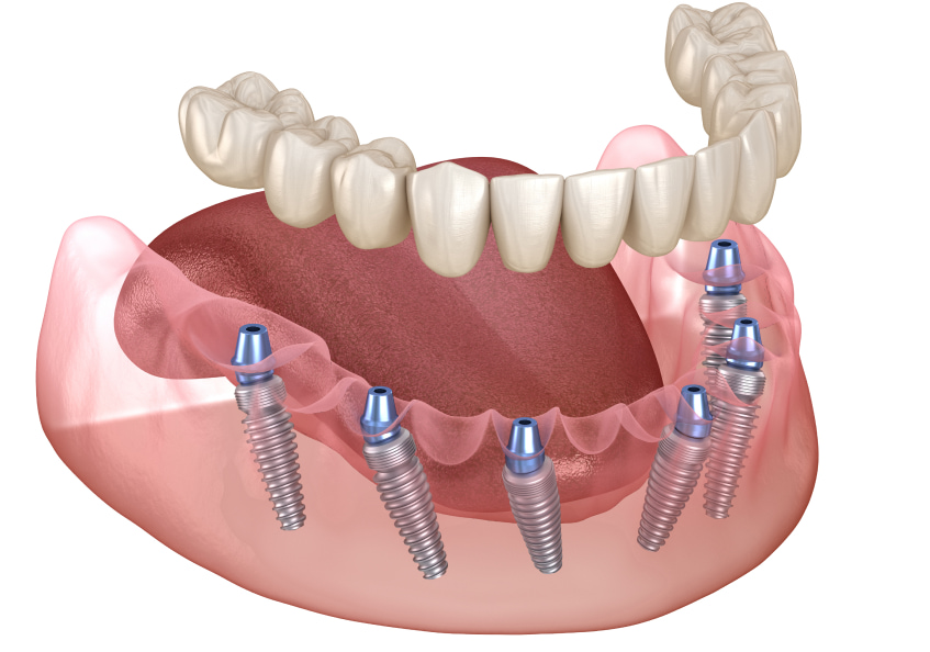 implant prosthetics