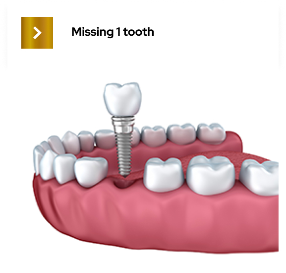 implant prosthetics