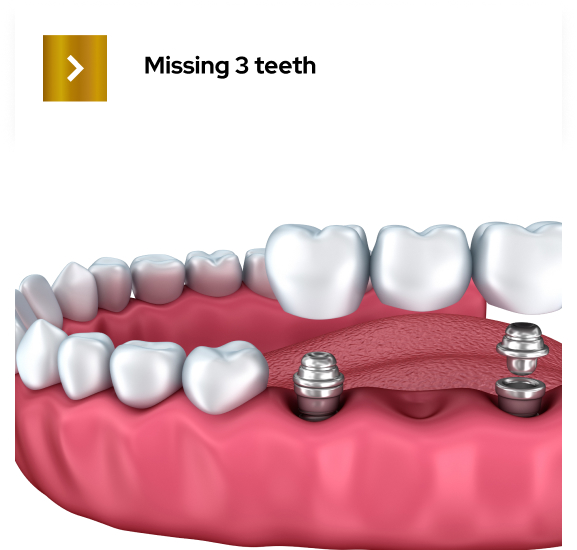 dental implants