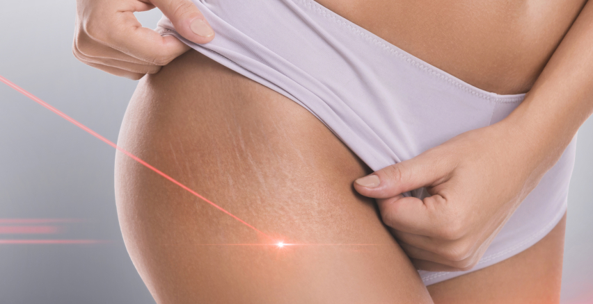 Laserowe usuwanie zmian skórnych