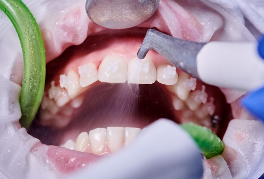 treatment of gum disease
