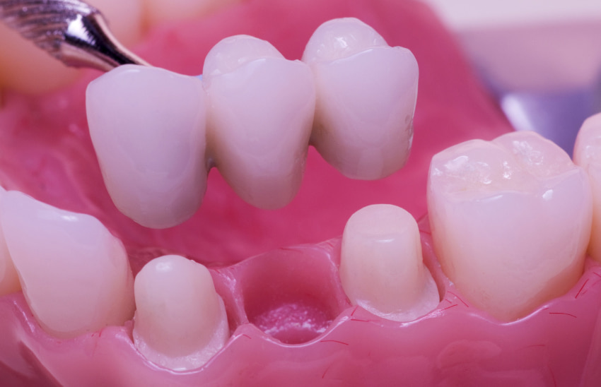 зубное протезирование - мостовидные протезы