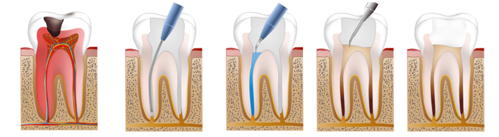root canal treatment of teeth