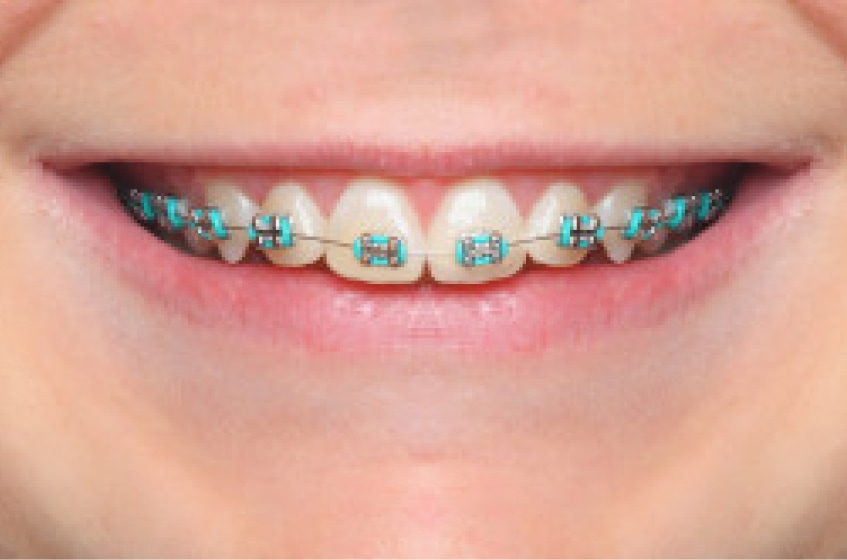 Orthodontics for children warsaw Odent