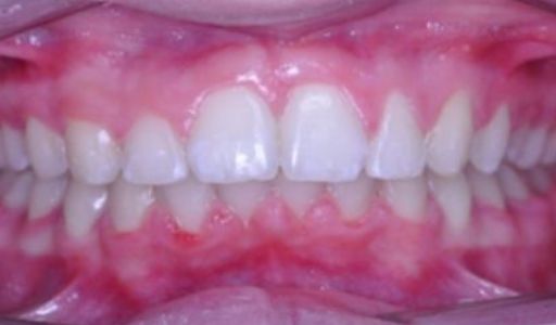 Efekty leczenia Ortodoncja