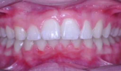 Effects of treatment Orthodontics