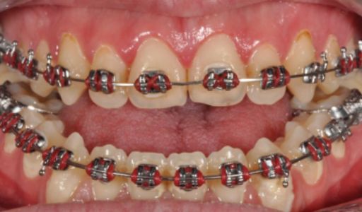 Effects of treatment Orthodontics