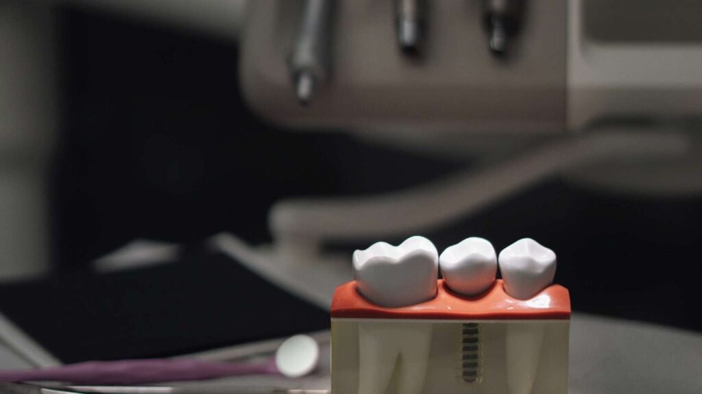 Kiedy implant zębowy będzie lepszym rozwiązaniem niż most