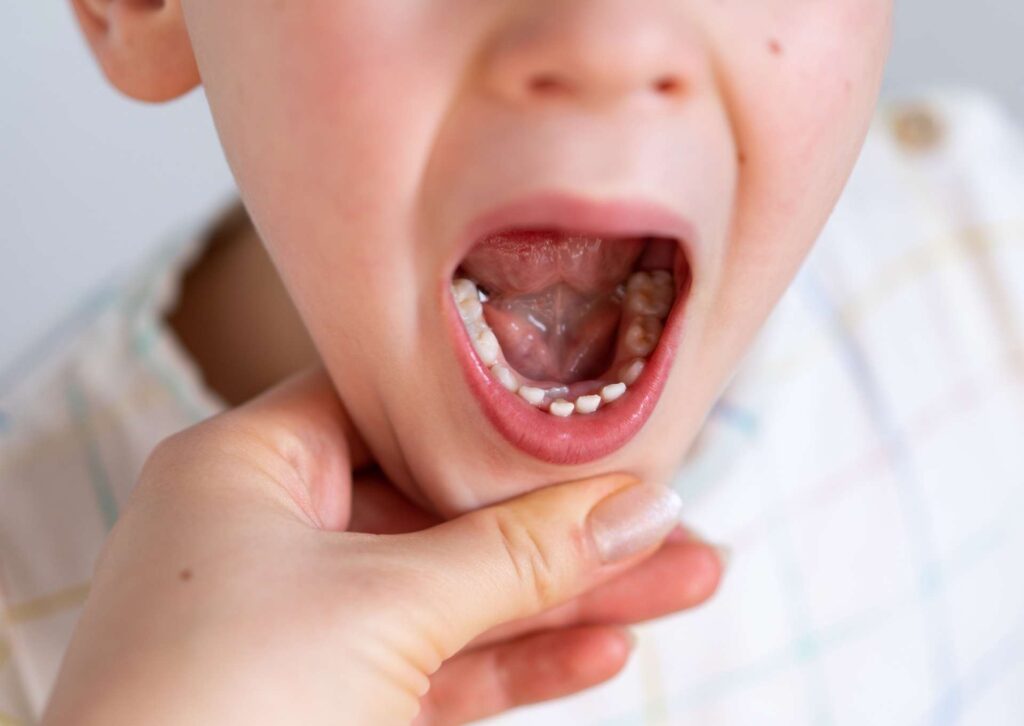 Dlaczego warto dbać o zęby mleczne już od pierwszego ząbka